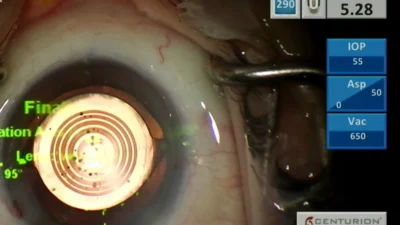 3. Geleneksel Canlı Cerrahi Sempozyumu’da canlı yayında dünyada ünlü göz