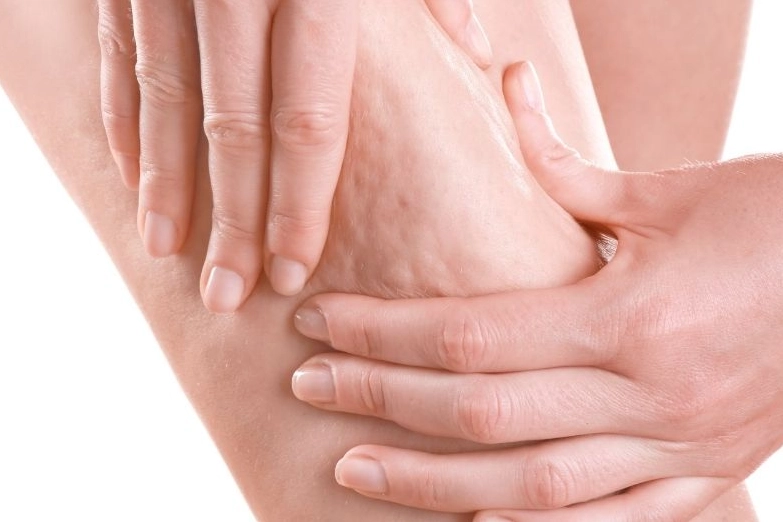 Estetik ve Plastik Cerrahi Uzmanı Prof. Dr. Ahmet Karacalar, selülitin